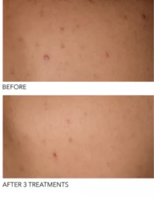 Earrings Alpha Beta Exfoliating Body Treatment Peel 8 Pk Dr Dennis Gross Earrings Alpha Beta Exfoliating Body Treatment Peel 8 Pk Dr Dennis Gross